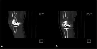 Staged <mark class="highlighted">open reduction and internal fixation</mark> with double-locking plates to treat bilateral distal femur periprosthetic fractures after total knee arthroplasty: A case report